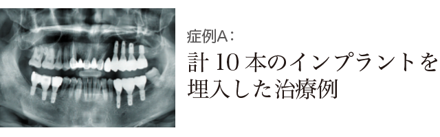 計10本のインプラントを埋入した治療例の写真