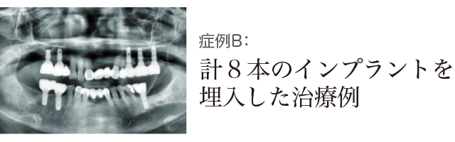 計8本のインプラントを埋入した治療例の写真